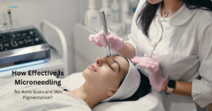microneedling for skin pigmentation and acne scar removal