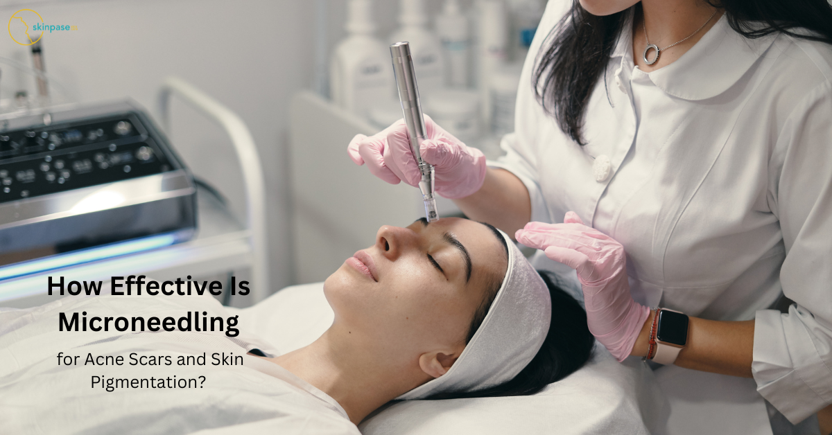 How Effective Is Microneedling for Acne Scars and Skin Pigmentation?
