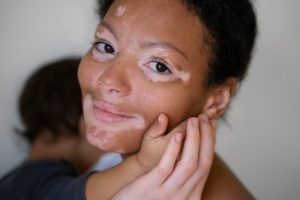 vitiligo treatment in kottayam at skinpase