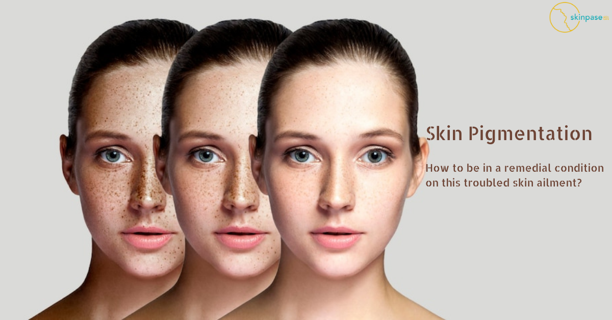 <strong>Skin pigmentation- How to be in a remedial condition on this troubled skin ailment?</strong>