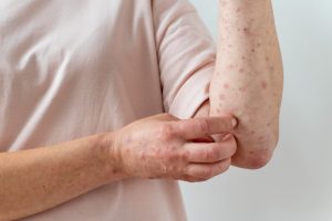 skin allergy treatment | Best skin clinic in kerala | Top Dermatologists in India