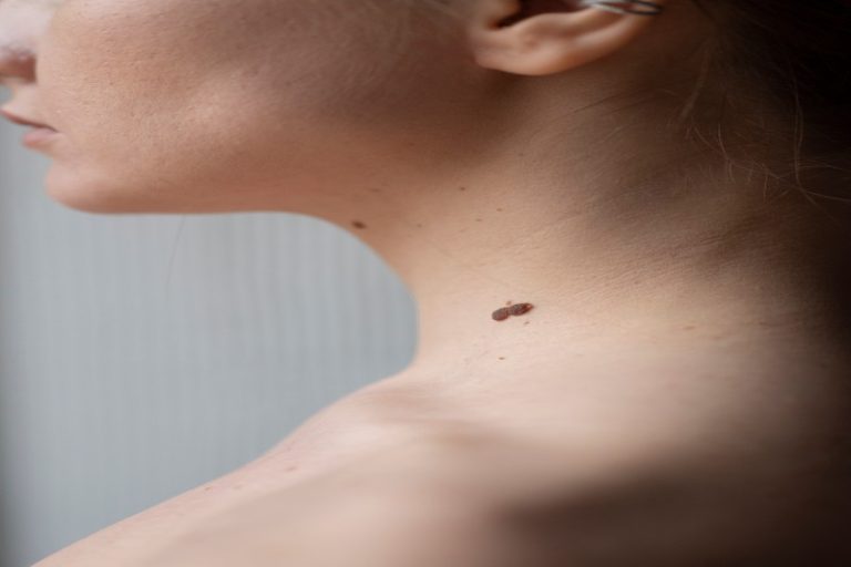 skin tag removal | Skin clinic in kerala | Top Dermatologists in India