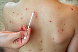 chicken pox scar removal | skin clinic kerala-kottayam | top dermatologists